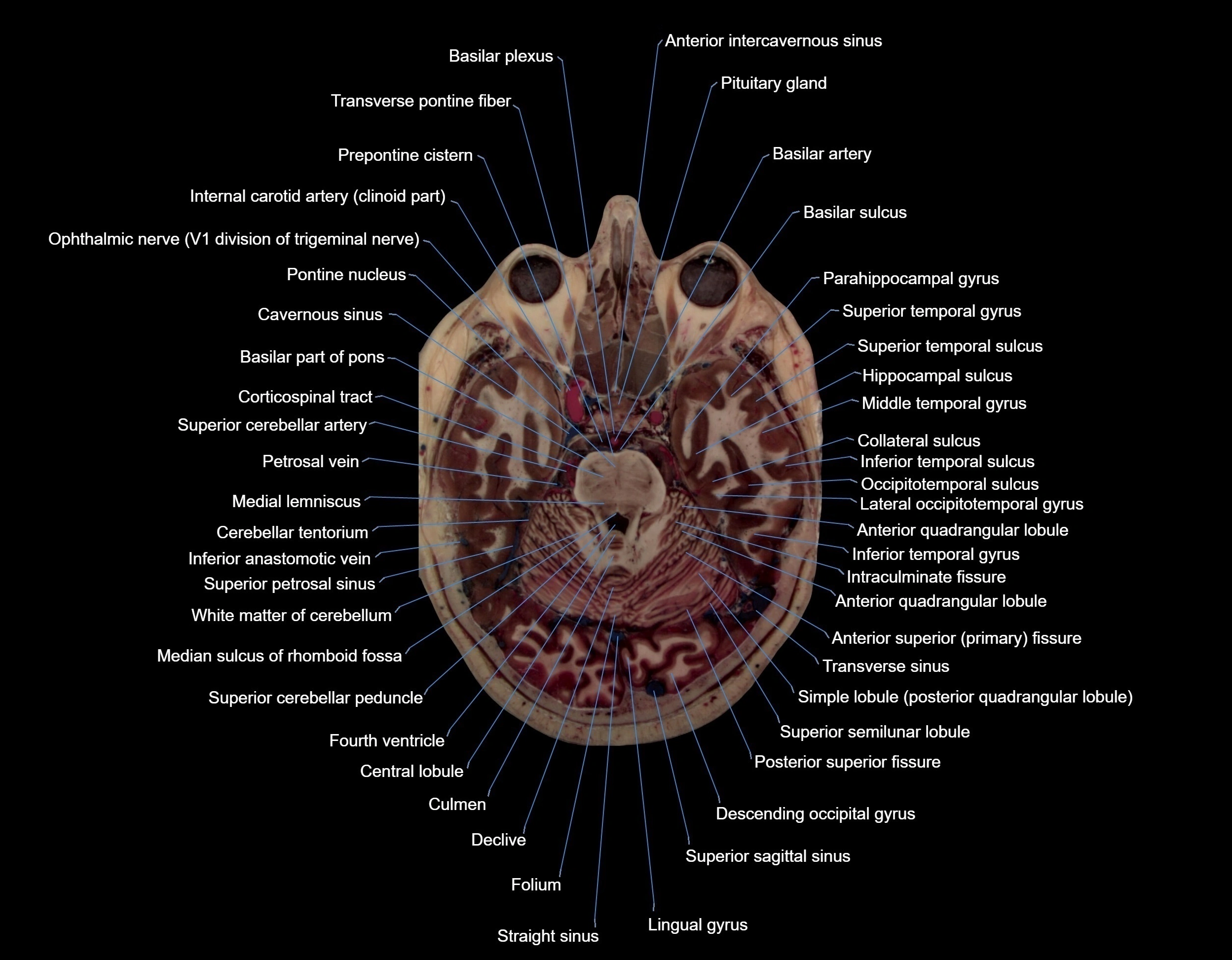 MRI Brain axial cross sectional radiology anatomy 3T image  -img-000026.webp